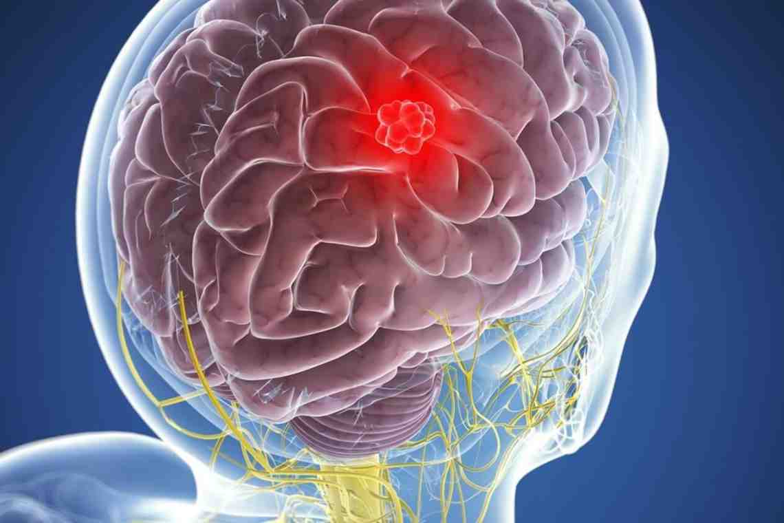 Рак мозга: причины, симптомы и постановка диагноза