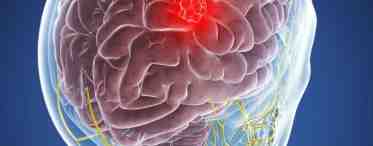 Рак мозга: причины, симптомы и постановка диагноза