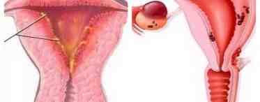 Толщина эндометрия. Гиперпластические процессы в слизистой матки
