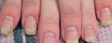 Заболевания ногтей: причины, типы и профилактика