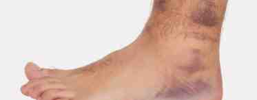 Растяжение связки голеностопа: причины, симптомы и методы лечения