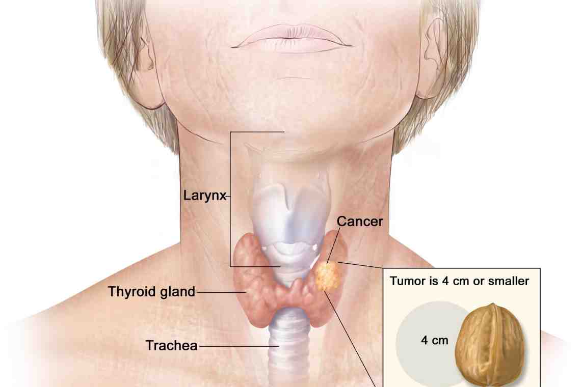 Узлы в щитовидной железе, симптомы и диагностика