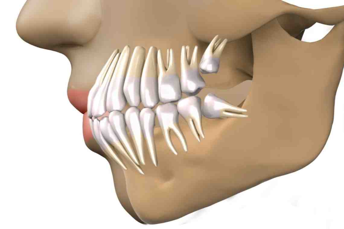 Растет зуб мудрости. Чего ждать и что делать?