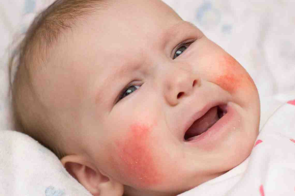 Как лечить детскую аллергию