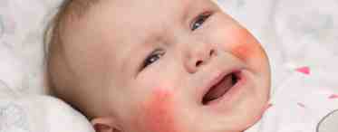 Как лечить детскую аллергию
