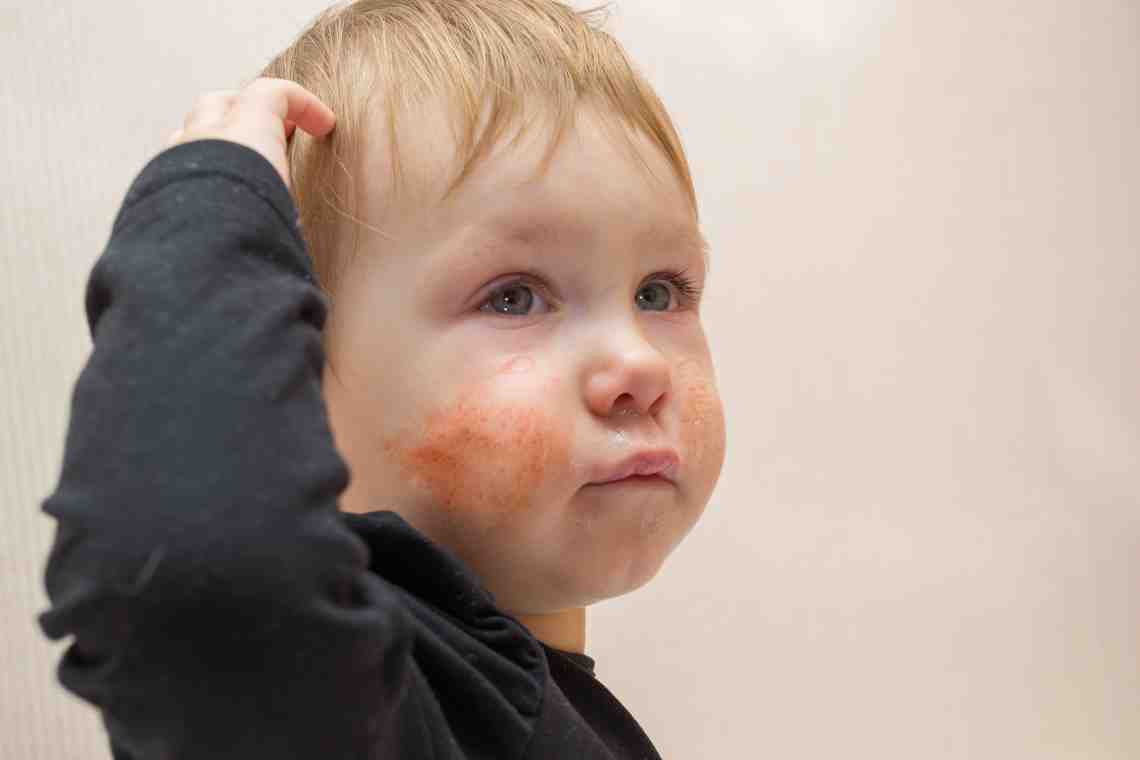 Может ли быть аллергия на тыкву у ребенка