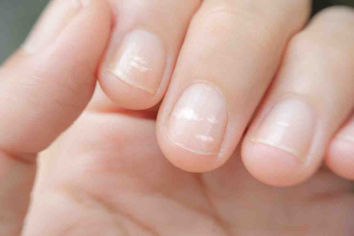 Как лечить ногти у ребенка