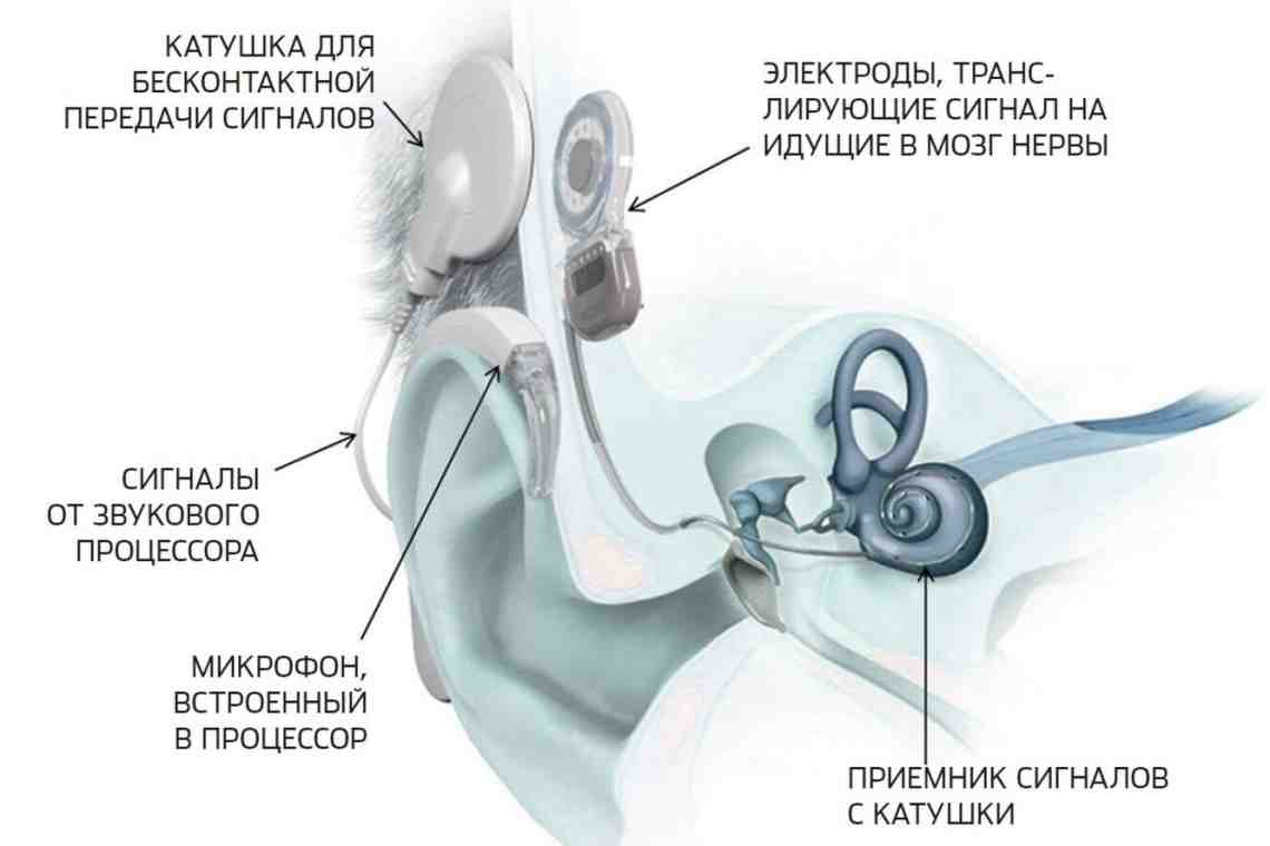 Слуховой аппарат внутреннего уха. Кохлеарная имплантация строение. Кохлеарный имплант строение. Слуховой аппарат кохлеарный имплант. Слуховой аппарат кохлеарный имплант операция.