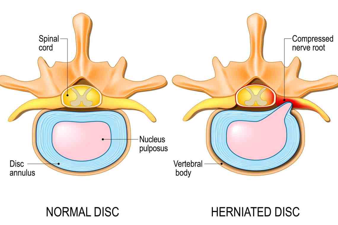 Spinal Hernia