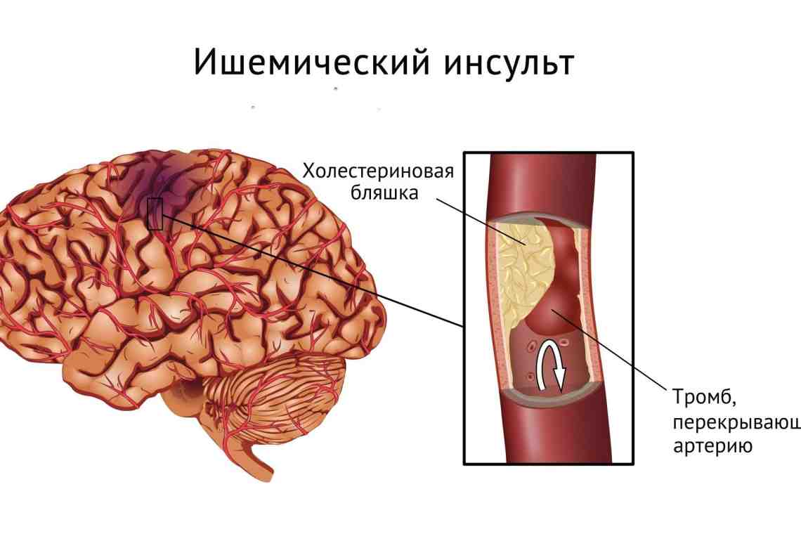 Дислокационный синдром - дислокация головного мозга: виды, причины, диагностика и лечение