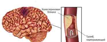 Дислокационный синдром - дислокация головного мозга: виды, причины, диагностика и лечение