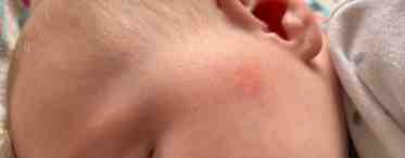 Почему появляются высыпания на лице у грудничка?