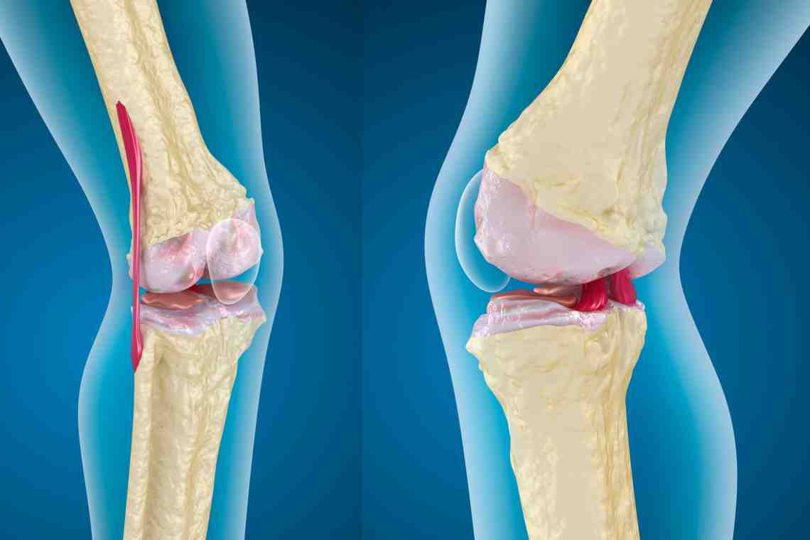 ДОА коленных суставов: причины, симптомы на разных стадиях, лечение