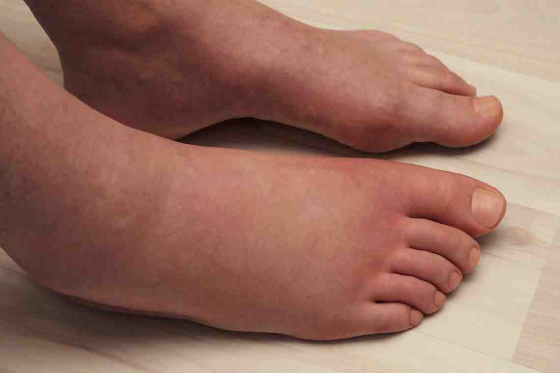 Отеки ног: лечение народными средствами