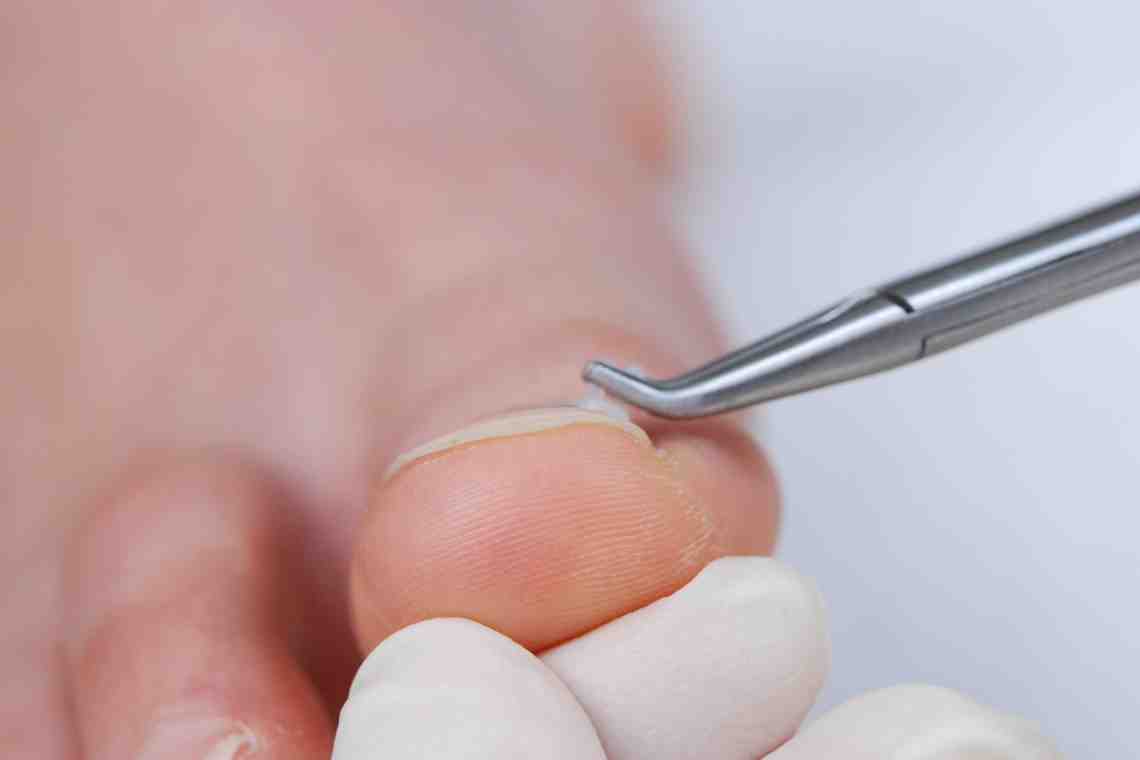 Ноготь врос в палец: причины и лечение
