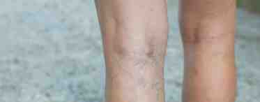 Видимые вены на ногах - причина варикоза?