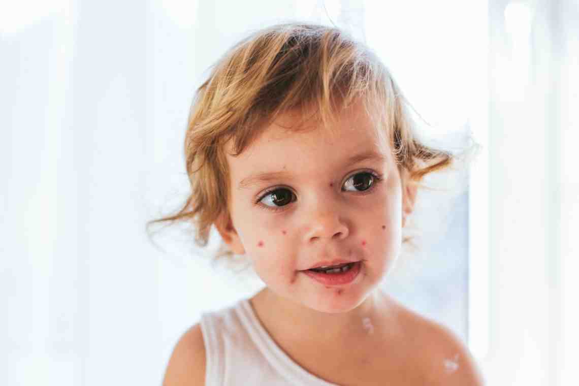 Лечение стрептодермии у ребенка: основные правила и особенности