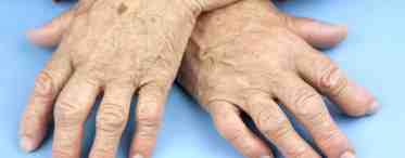 Возможно ли лечение артрита пальцев рук дома?