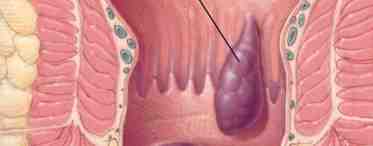 Что такое парапроктит? Симптомы заболевания