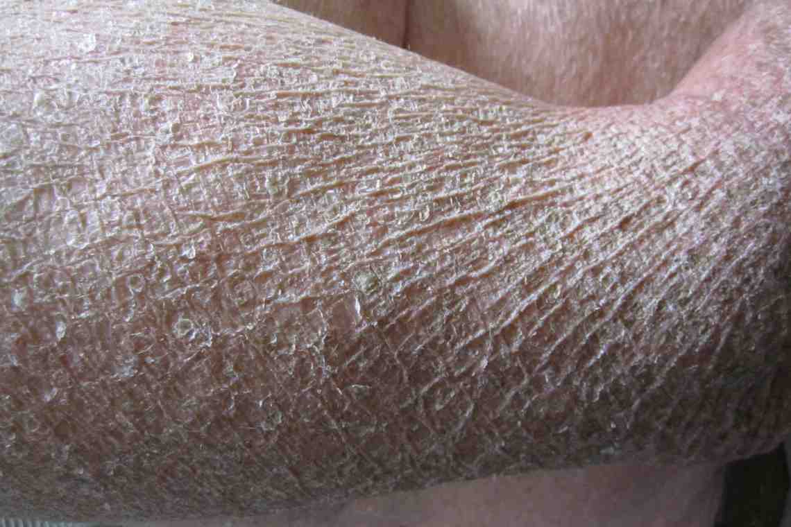 Некоторые болезни кожи человека