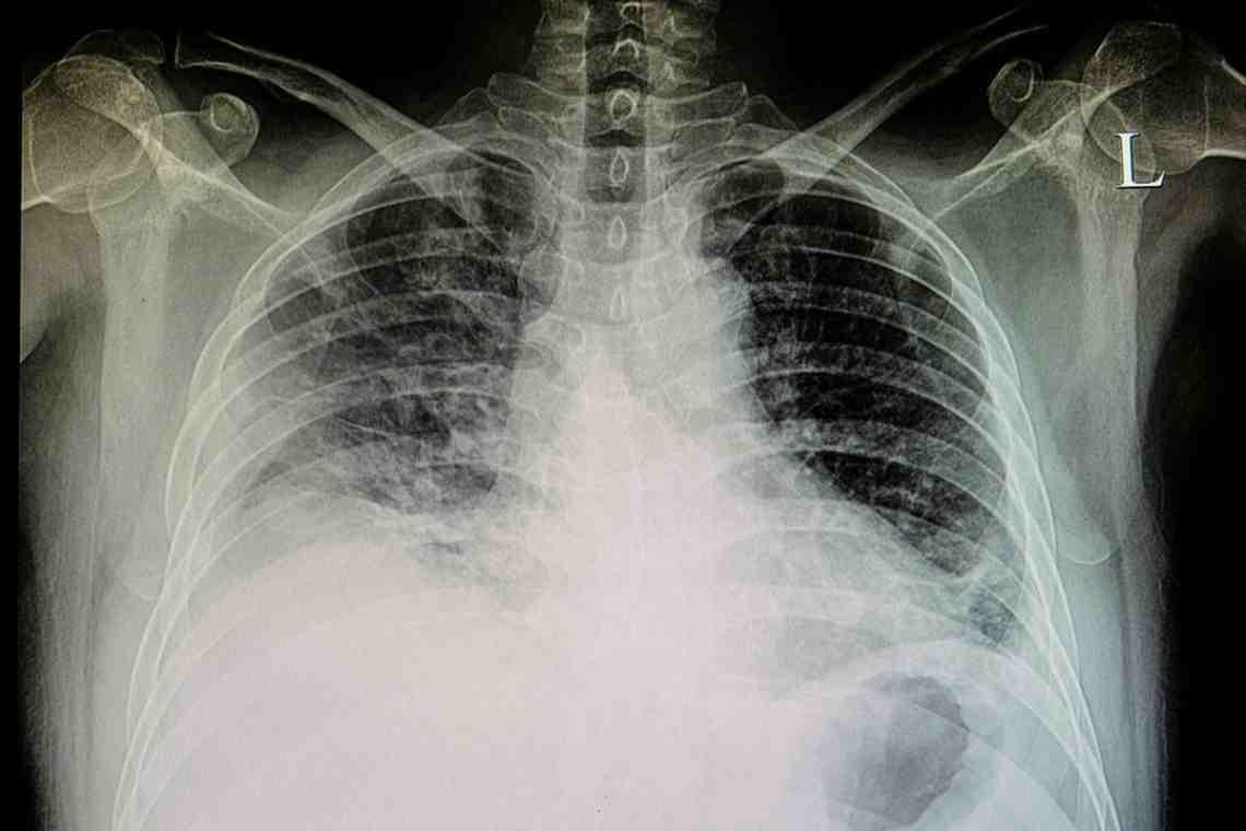 Рентгеноскопия грудной клетки отек легких