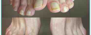 Симптомы грибка ногтей на ногах, характеристики и разновидности