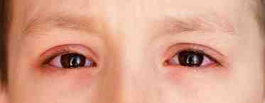 Красные глаза у ребенка: причины, лечение и профилактика