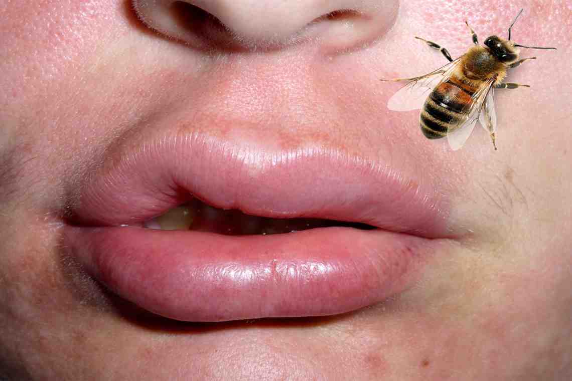 Консультация специалиста: что делать, если укусила пчела