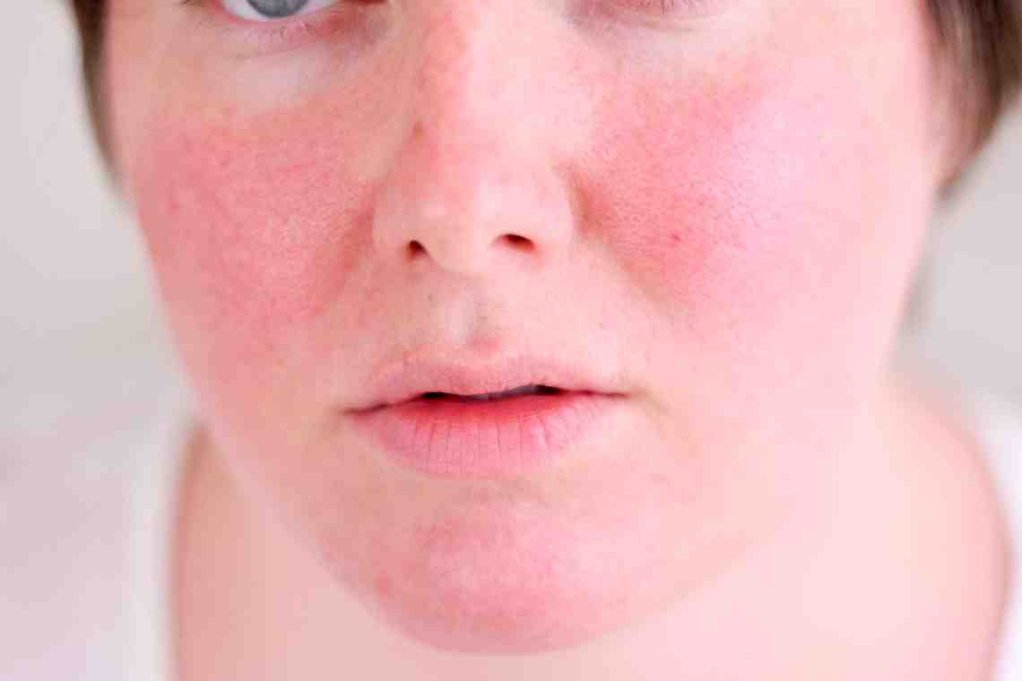 На лице появились красные пятна: возможные причины, диагностика и методы лечения