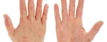Пальцы на руках трескаются: причины и лечение