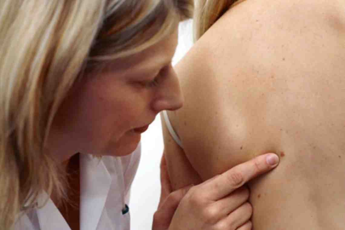 Симптомы рака груди у мужчин. Раковые поражения кожи. Раковые проявления на коже.