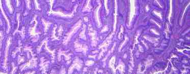 Что такое железистая гиперплазия эндометрия?