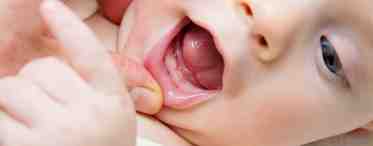 Молочница у грудного ребенка: причины и симптомы
