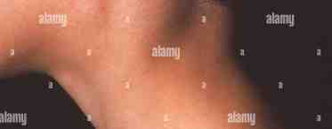 Воспаление лимфоузлов на шее у ребенка: причины и лечение