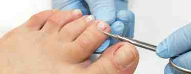 Как проводить лечение вросшего ногтя в домашних условиях?