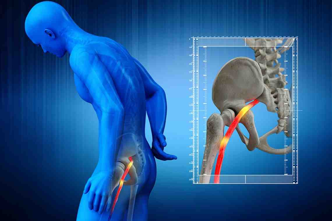 Защемление седалищного нерва: лечение, симптомы, причины