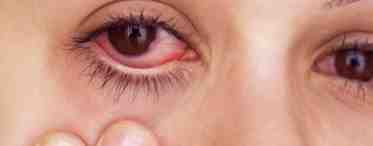Слезятся глаза: причина, симптомы заболеваний и их лечение
