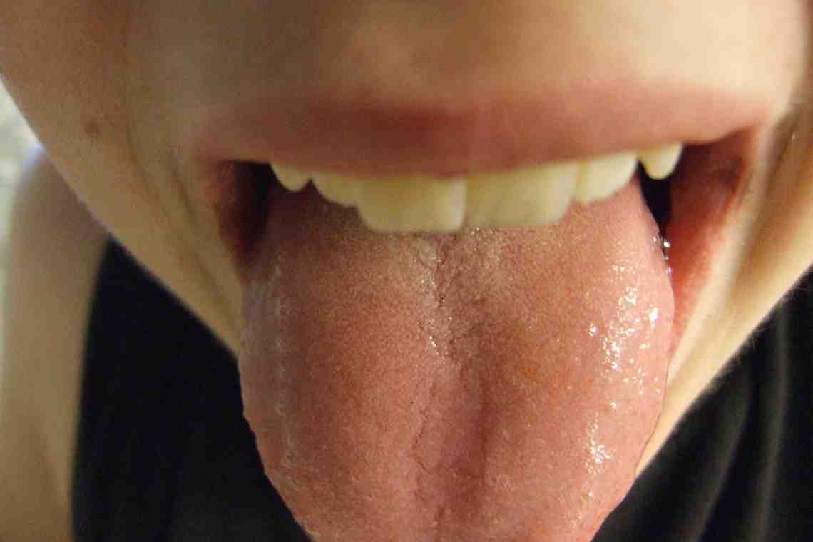 Желтый налет на языке: причины возникновения и особенности лечения