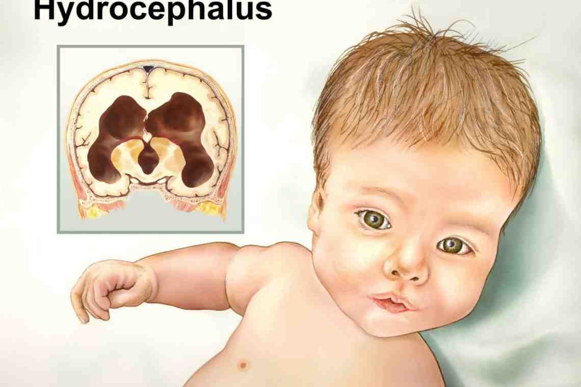 Киста мозга у новорожденного – виды, причины и особенности лечения
