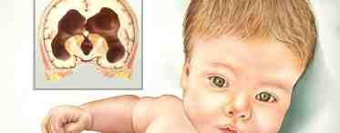 Киста мозга у новорожденного – виды, причины и особенности лечения