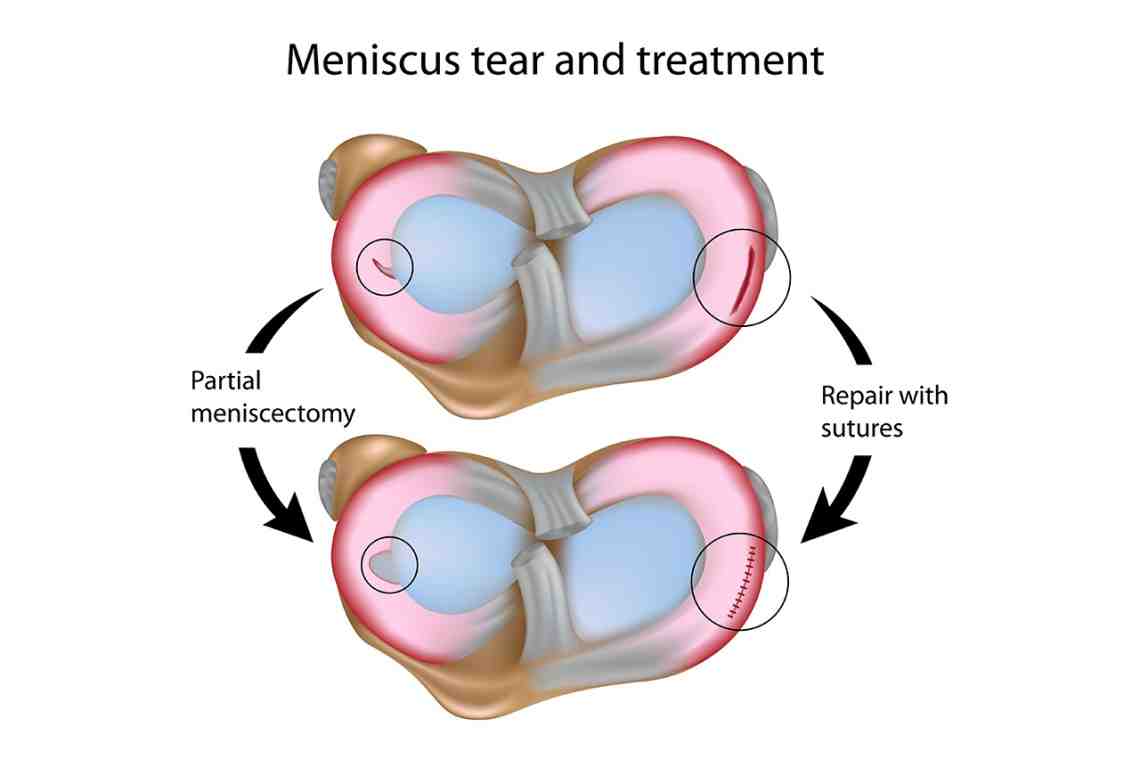 Симптомы и лечение мениска коленного сустава