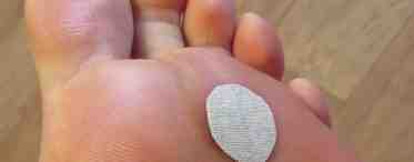 Шипица на пальце: причины появления, лечение медикаментами и народными средствами