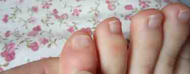 Эффективное лечение грибка между пальцами ног