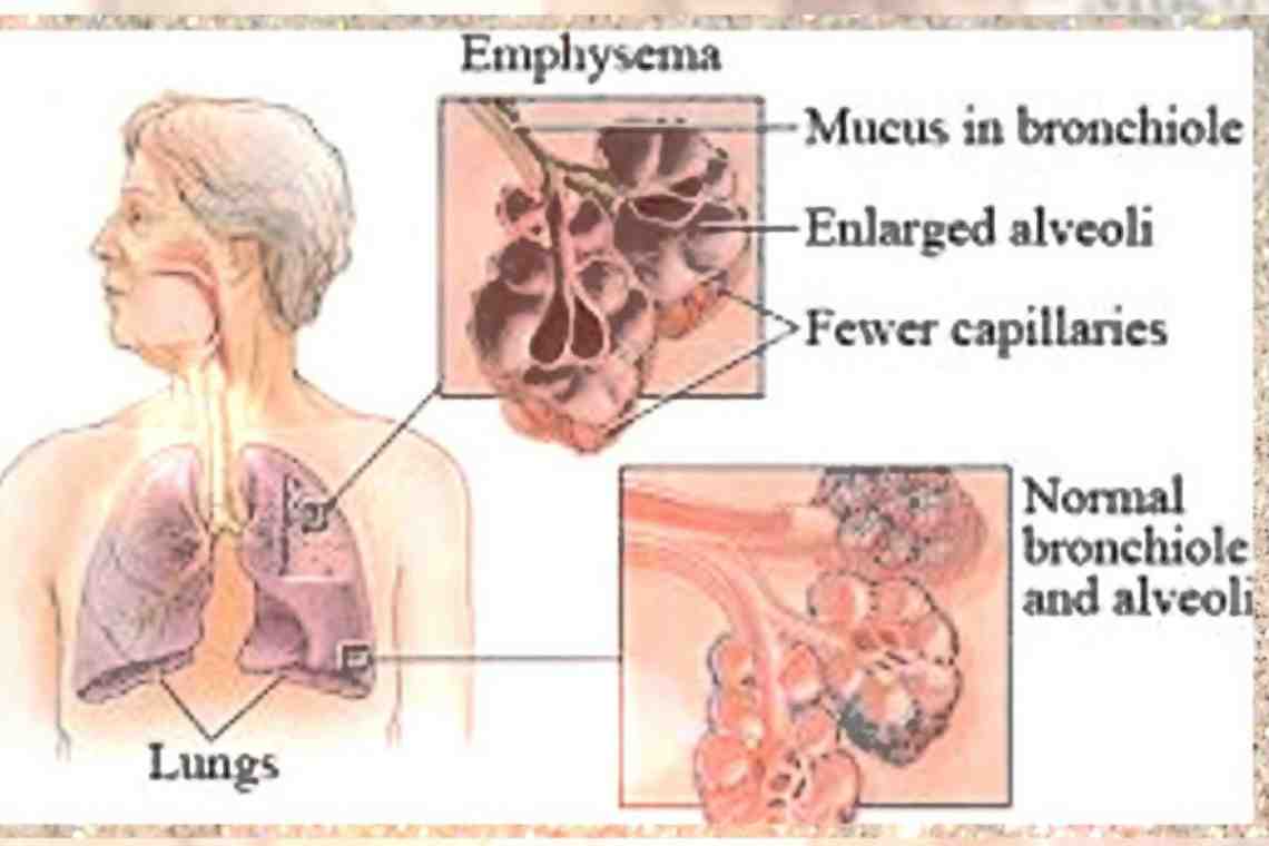 Причины и симптомы эмфиземы легких