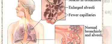 Основные симптомы язвы желудка и гастрита