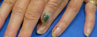 Опасны ли болезни ногтей на руках?