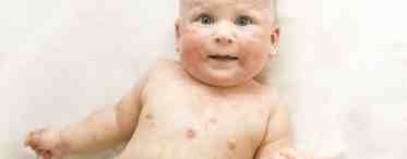 Аллергия у грудного ребенка не повод отчаиваться