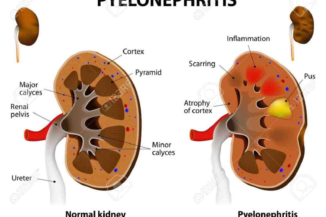 Что такое пиелонефрит? Причины, симптомы, диагностика, лечение и профилактика пиелонефрита