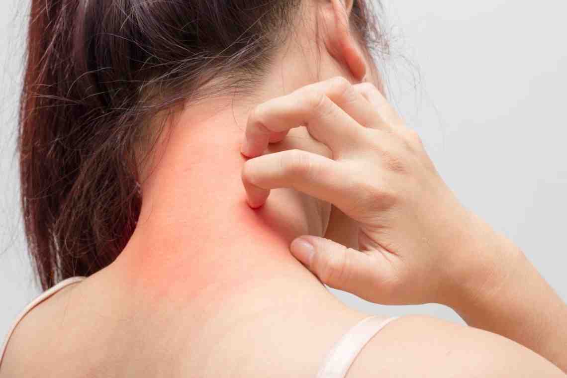 Аллергия на теле. Как ее узнать и победить
