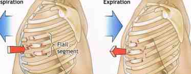 Лечение переломов ребер - полезные советы и рекомендации
